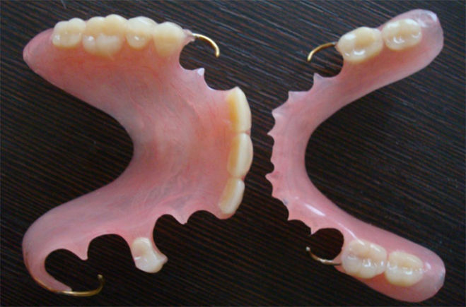 Частичные съемные пластиночные протезы на верхнюю и нижнюю челюсти с напыленными кламмерами