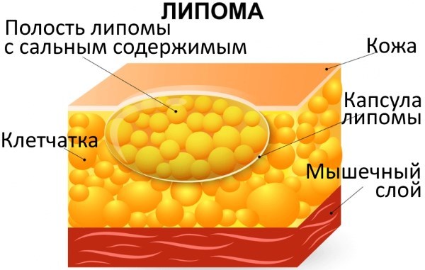 жировик - липома