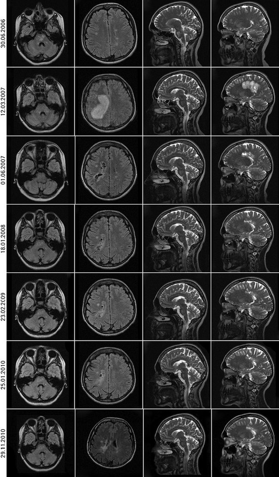 Результат томографии головного мозга