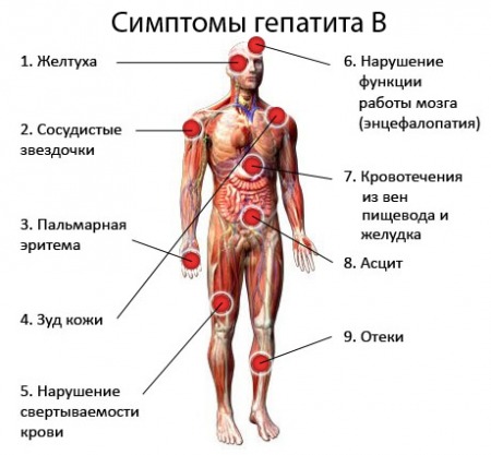 симптомы гепатита B