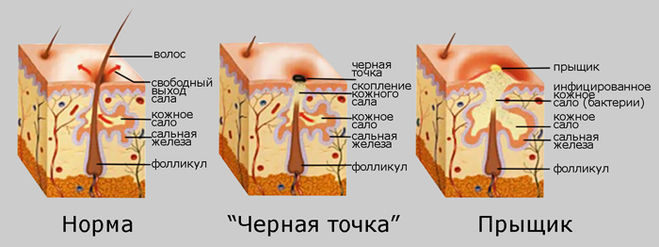 схема образования угрей и прыщей