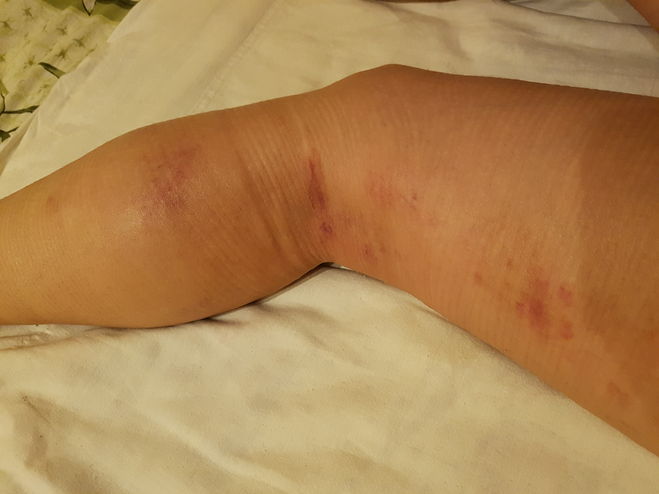 Моя нога на третий день после уколов.