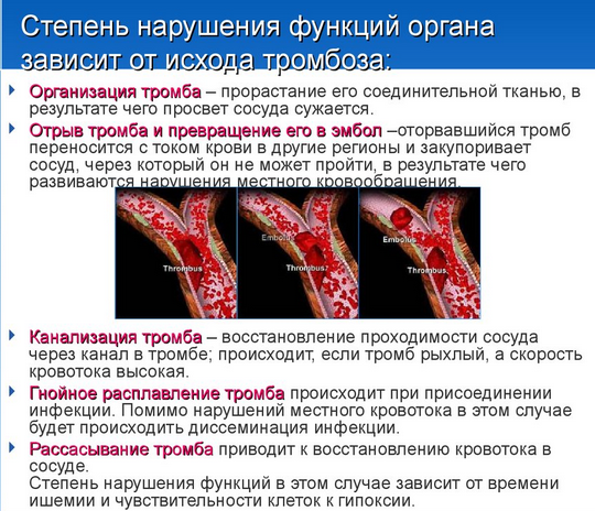 что значит оторвался тромб