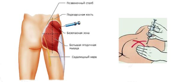 делим ягодицу по зонам