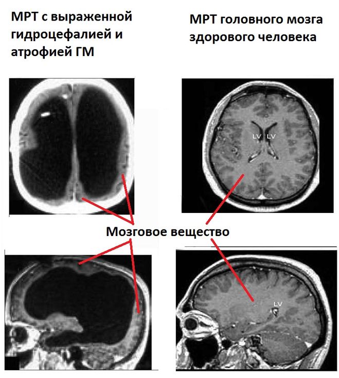 атрофия мозга