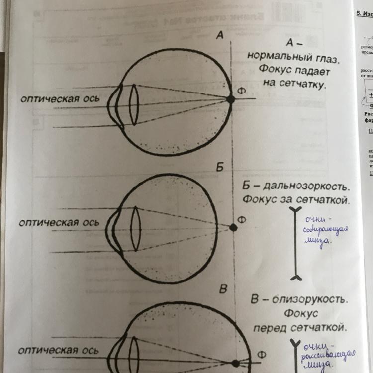 Расположение фокуса. Оптическая ось глаза. Нормальный фокус на сетчатке. Оптическая система глаза.фокус. Что перед сетчаткой глаза.