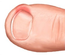 Из-за неправильного подстригания ногтей появляется всякая бяка на пальчиках.