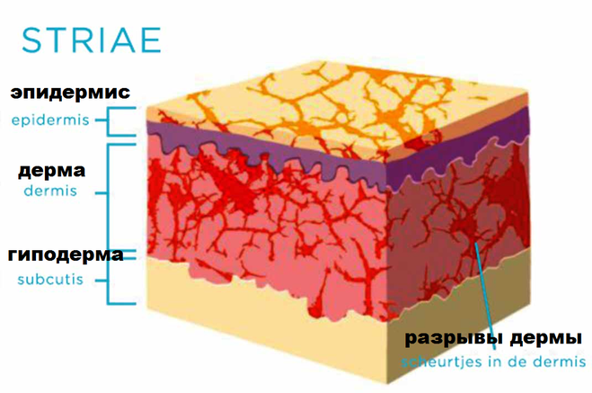стрии растяжки, схема