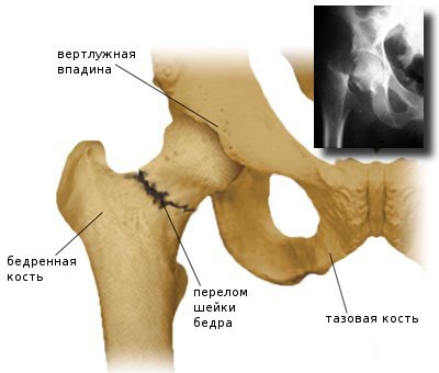 Перелом шейки бедра