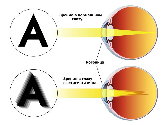 текст при наведении астигматизм