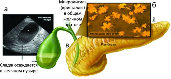 билиарный сладж