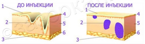 заполнение гиалуроновой кислотой