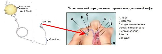 Установка порта. Подключичный порт для химиотерапии. Порт катетер подкожный. Артериальный порт для химиотерапии. Подкожная помпа для химиотерапии.